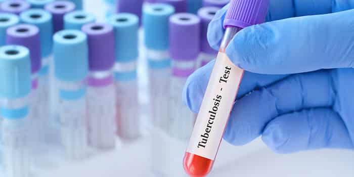 California Casino Warns Visitors After Tribal Member Tests Positive for Tuberculosis